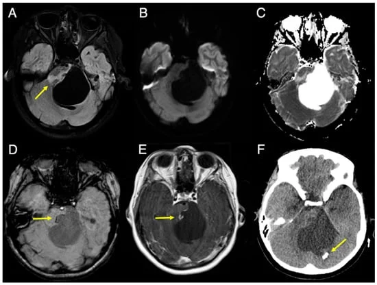 a-five-year-medical-mystery-unraveling-the-enigma-of-coats-plus-syndrome