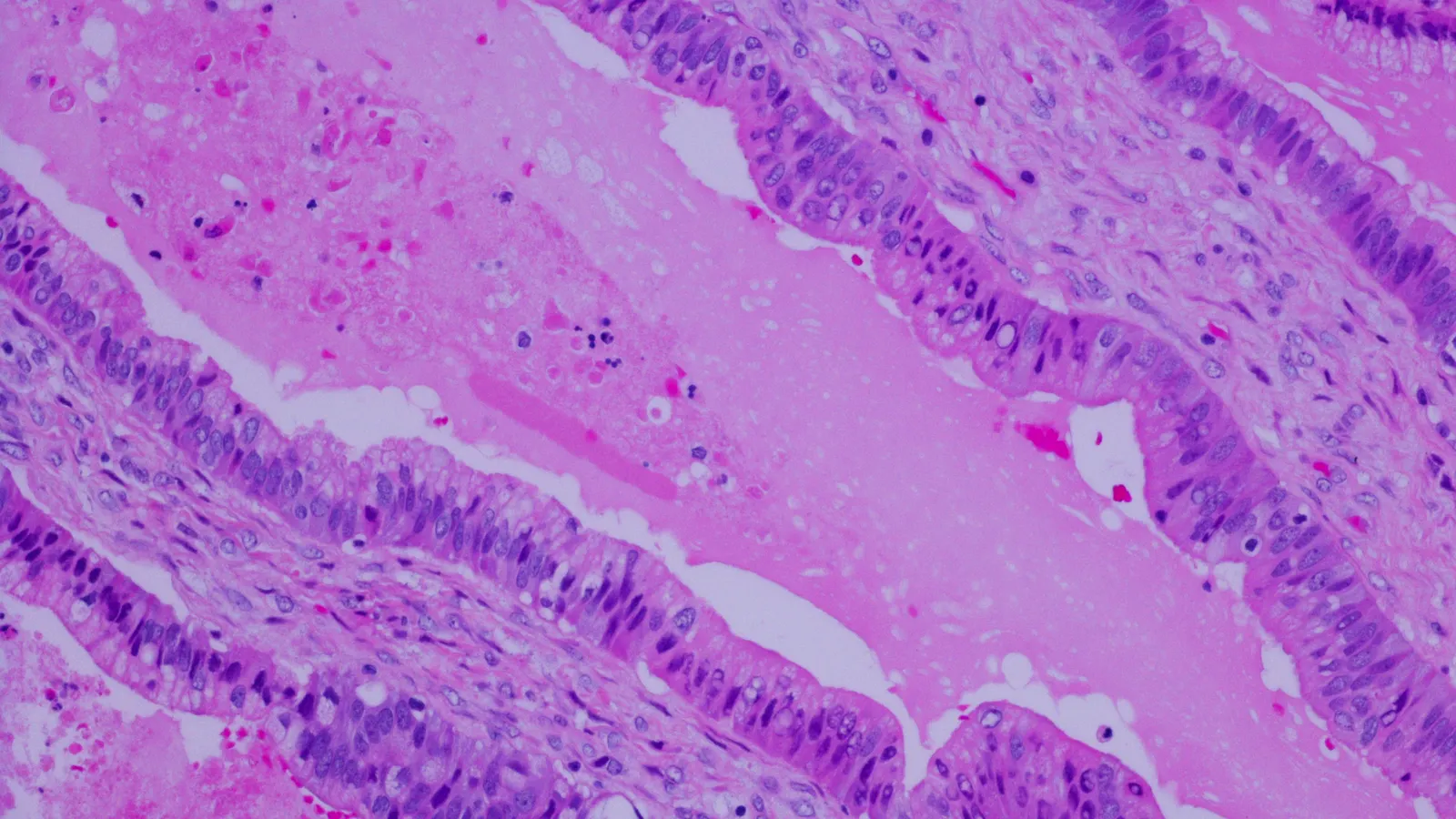 a-new-horizon-revolution-medicines-breakthrough-drug-could-redefine-pancreatic-cancer-treatment