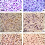 breakthrough-in-pathology-new-molecular-markers-identified-to-distinguish-between-rare-langerhans-cell-neoplasms
