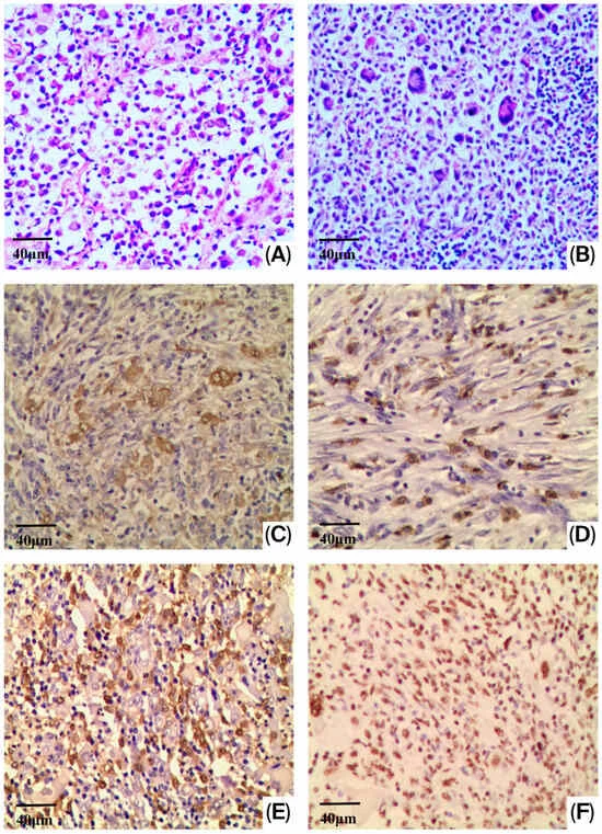 breakthrough-in-pathology-new-molecular-markers-identified-to-distinguish-between-rare-langerhans-cell-neoplasms