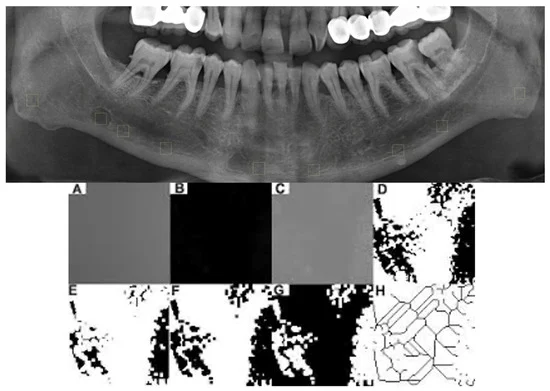 decoding-the-stafne-bone-cavity-new-insights-into-a-century-old-radiological-enigma