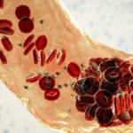 jupiter-endovasculars-vertex-system-shows-remarkable-efficacy-in-treating-severe-pulmonary-embolism-reversing-right-heart-strain