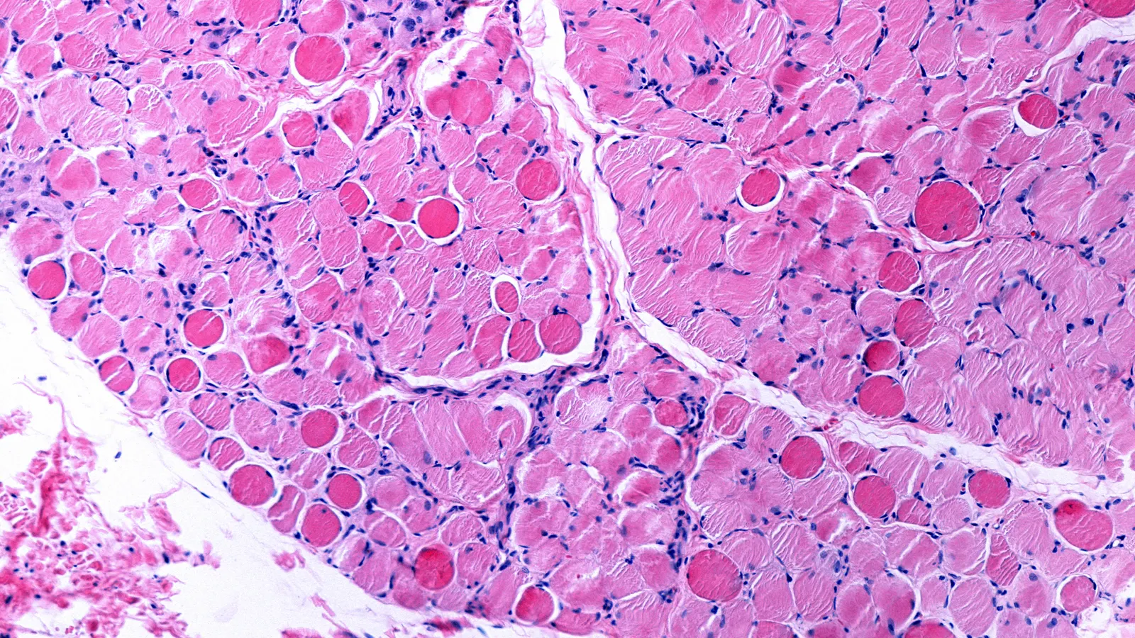 navigating-the-tightrope-regenxbios-bid-for-duchenne-gene-therapy-approval-amid-regulatory-flux