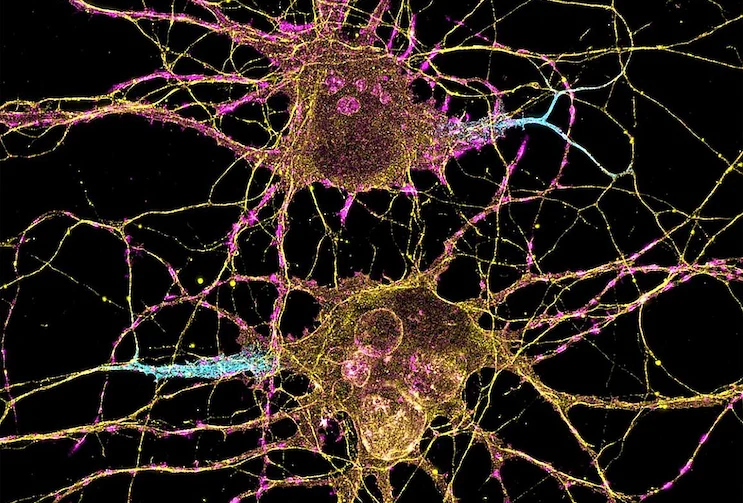 precision-rewriting-a-new-era-in-treating-dravet-syndrome