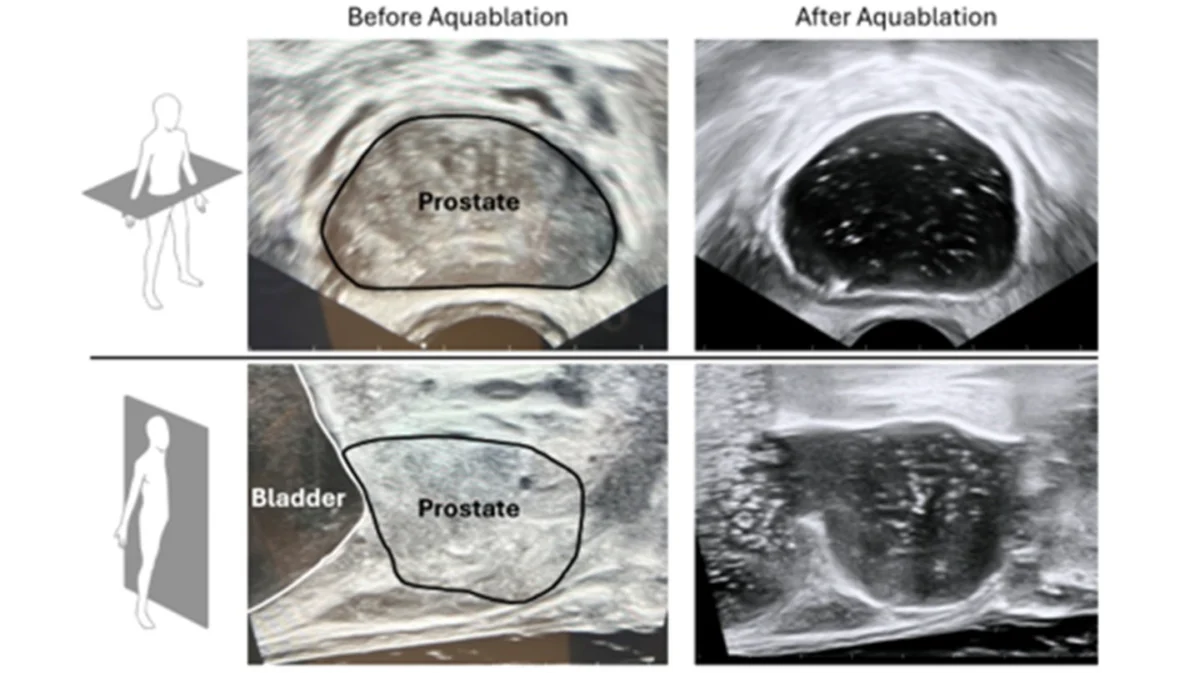 procept-biorobotics-expands-clinical-frontiers-new-fda-clearance-marks-evolution-in-prostate-cancer-treatment