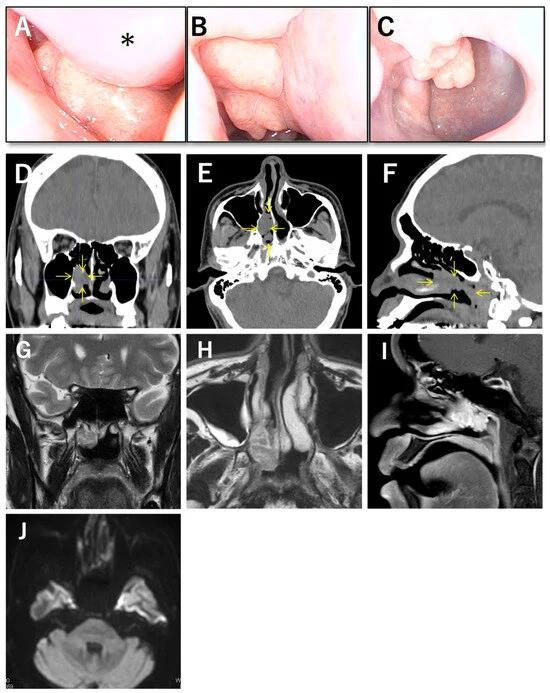 the-diagnostic-puzzle-of-seromucinous-hamartoma-bridging-the-gap-between-biopsy-and-clinical-reality
