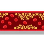 tryngolza-shows-significant-promise-in-severe-hypertriglyceridemia-potentially-challenging-market-leader-redemplo