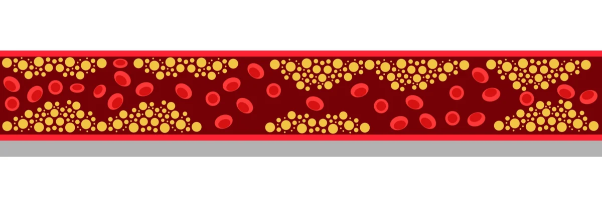 tryngolza-shows-significant-promise-in-severe-hypertriglyceridemia-potentially-challenging-market-leader-redemplo