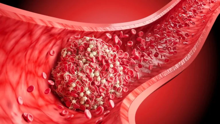 advancing-stroke-care-penumbra-receives-fda-clearance-for-thunderbolt-thrombectomy-platform
