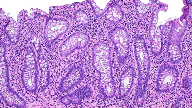 campfield-therapeutics-emerges-with-180m-series-a-to-disrupt-the-ibd-treatment-landscape