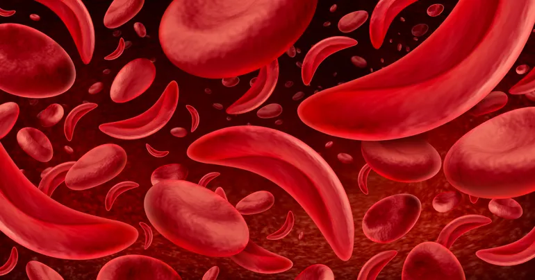 crossroads-for-fulcrum-therapeutics-strategic-review-initiated-following-fda-mandated-halt-to-sickle-cell-program