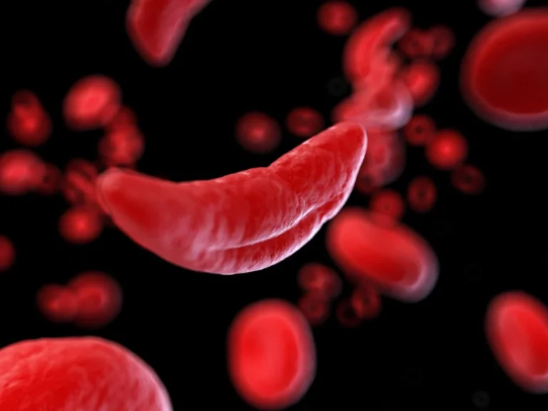 sickle-cell-disease-a-growing-global-health-crisis-demanding-urgent-action