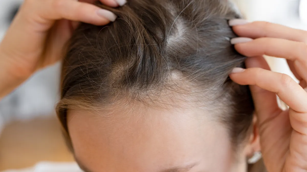 biotech-breakthrough-veradermics-oral-minoxidil-trial-marks-potential-paradigm-shift-in-hair-loss-treatment