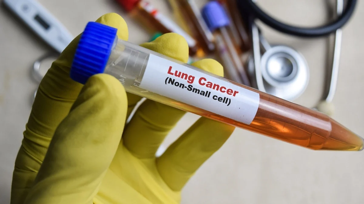 landmark-trial-initiated-for-novel-cancer-therapy-targeting-small-cell-lung-cancer