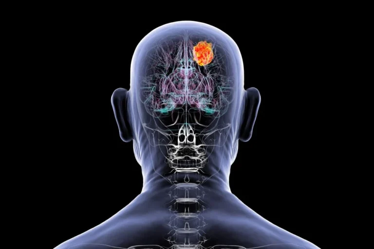 nuvation-bio-accelerates-glioma-drug-development-with-pivotal-global-trial-and-new-phase-ii-study