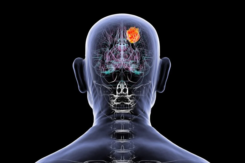 nuvation-bio-accelerates-glioma-drug-development-with-pivotal-global-trial-and-new-phase-ii-study