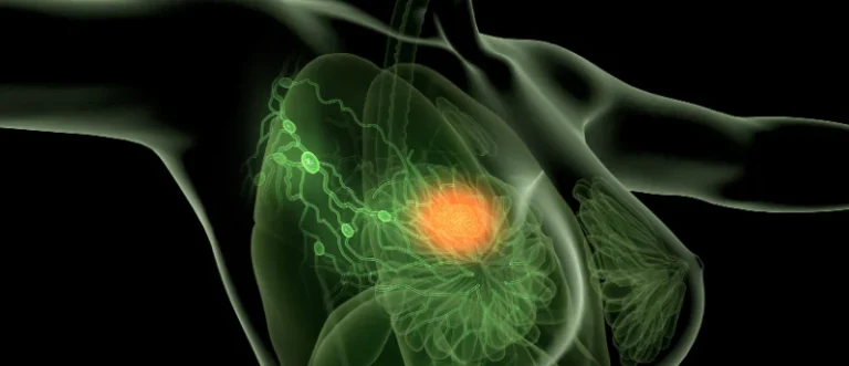 precision-medicine-breakthrough-i31-slnb-test-outperforms-traditional-nomograms-in-melanoma-management