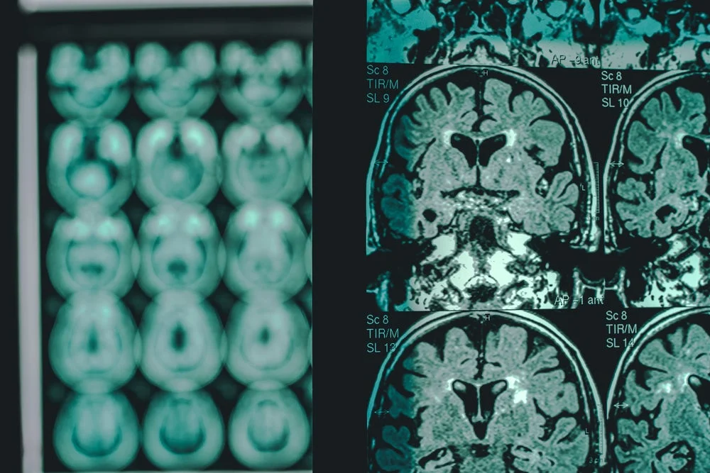 roche-expands-trontinemabs-horizon-in-alzheimers-fight-with-pre-symptomatic-trial-and-promising-phase-iii-data