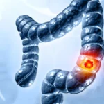 the-future-of-colorectal-cancer-screening-freenome-and-abbotts-high-stakes-path-to-market-dominance
