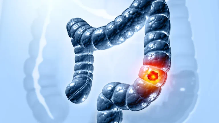 the-future-of-colorectal-cancer-screening-freenome-and-abbotts-high-stakes-path-to-market-dominance