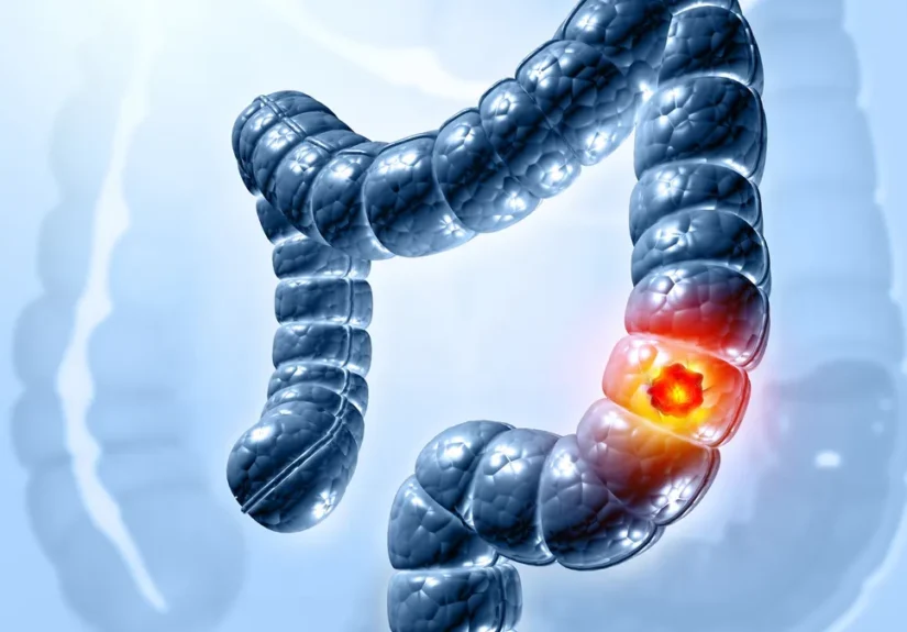 the-future-of-colorectal-cancer-screening-freenome-and-abbotts-high-stakes-path-to-market-dominance