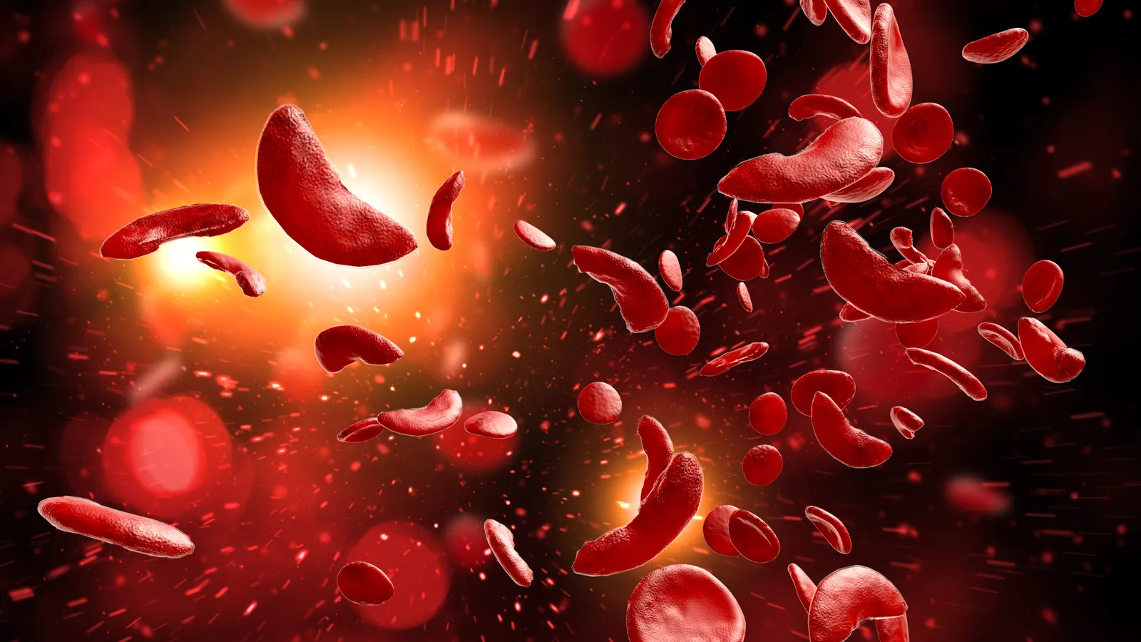the-sickle-cell-graveyard-agios-joins-list-of-companies-facing-clinical-setbacks