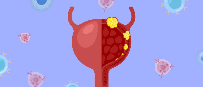 a-new-horizon-in-uro-oncology-cretostimogene-grenadenorepvec-offers-bladder-sparing-hope-for-high-risk-cancer-patients