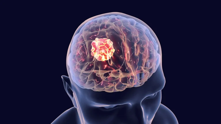 breakthrough-in-brain-cancer-treatment-usc-researchers-uncover-potent-triple-therapy-for-glioblastoma