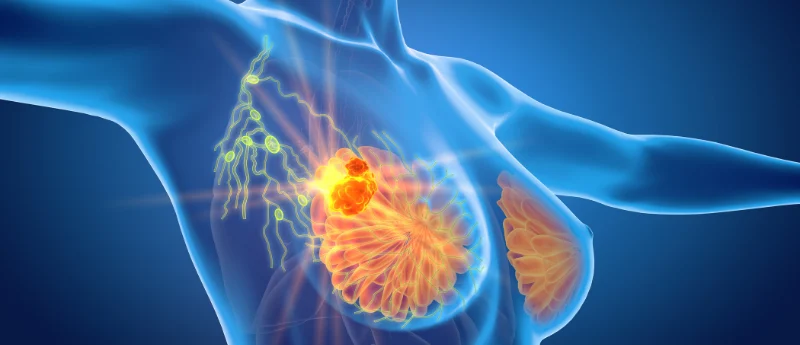 new-horizons-in-breast-cancer-care-eu-regulatory-breakthroughs-redefine-treatment-landscapes