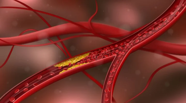 the-silent-epidemic-react-study-reveals-early-onset-atherosclerosis-crisis