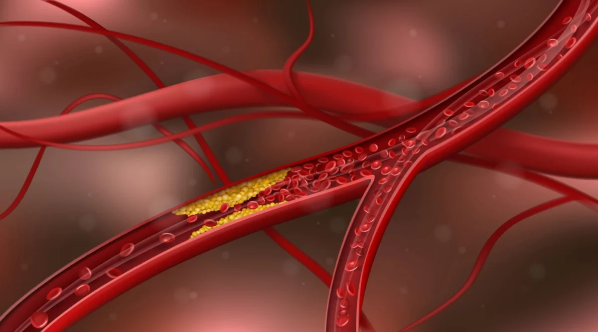 the-silent-epidemic-react-study-reveals-early-onset-atherosclerosis-crisis