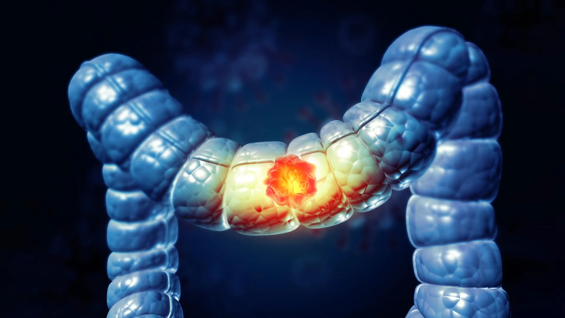 unlocking-the-colorectal-cancer-paradox-msk-researchers-discover-dual-nature-of-immune-cells-paving-way-for-precision-immunotherapy