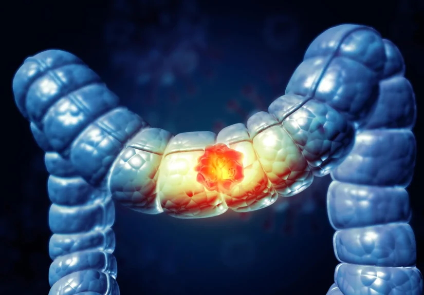 unraveling-the-colorectal-cancer-paradox-new-study-pinpoints-dual-roles-of-immune-cells-paving-way-for-precision-immunotherapy