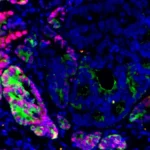 unveiling-the-master-switch-researchers-identify-key-epigenetic-factor-driving-colorectal-cancers-deadly-spread-to-the-liver