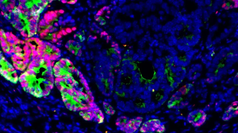unveiling-the-master-switch-researchers-identify-key-epigenetic-factor-driving-colorectal-cancers-deadly-spread-to-the-liver