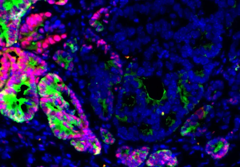 unveiling-the-master-switch-researchers-identify-key-epigenetic-factor-driving-colorectal-cancers-deadly-spread-to-the-liver