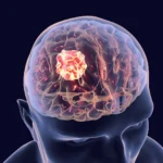a-new-dawn-in-glioblastoma-treatment-keck-medicine-of-usc-unveils-promising-combination-therapy