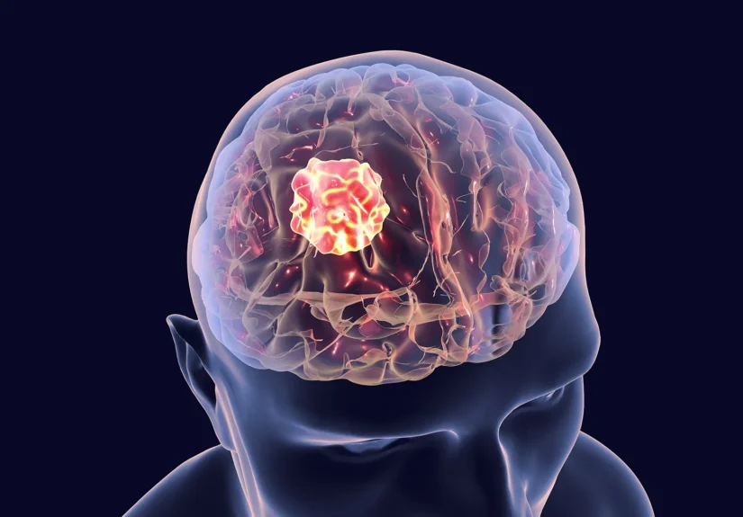 a-new-dawn-in-glioblastoma-treatment-keck-medicine-of-usc-unveils-promising-combination-therapy