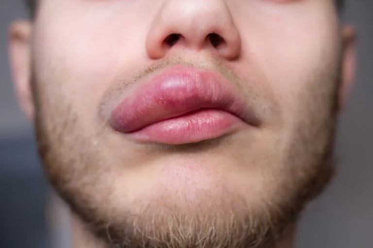 argo-biopharmaceuticals-bw-20805-shows-promising-mid-stage-results-poised-to-disrupt-highly-competitive-hereditary-angioedema-market