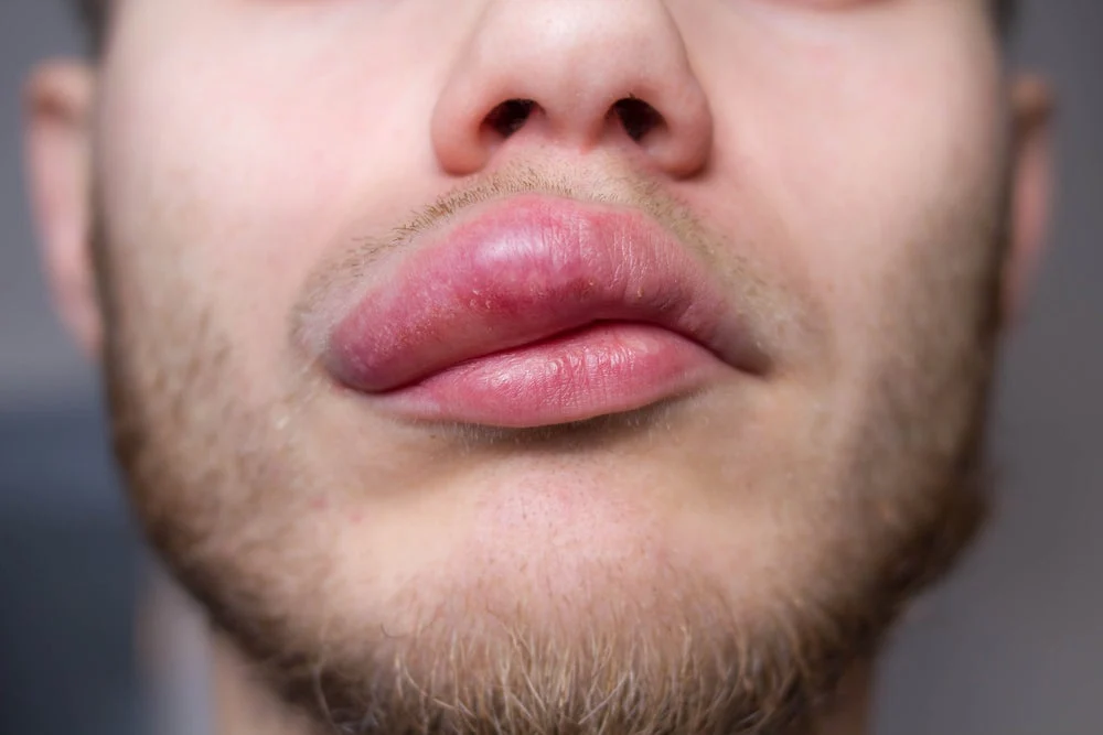 argo-biopharmaceuticals-bw-20805-shows-promising-mid-stage-results-poised-to-disrupt-highly-competitive-hereditary-angioedema-market