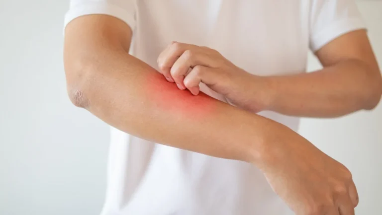 bionyra-pharma-initiates-phase-i-trial-for-novel-atopic-dermatitis-therapy-byn-001-targeting-upstream-inflammatory-pathway