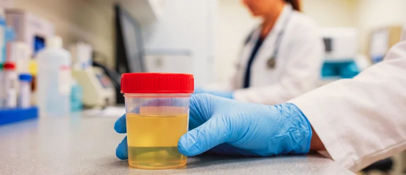 breakthrough-in-bladder-cancer-diagnostics-new-genomic-urine-test-shows-near-perfect-accuracy-in-nhs-trial