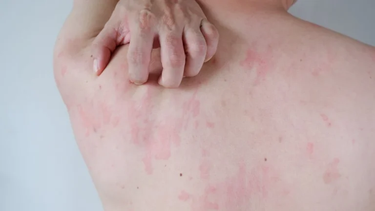 celldexs-barzolvolimab-shows-significant-promise-in-chronic-spontaneous-urticaria-paving-way-for-fda-submission