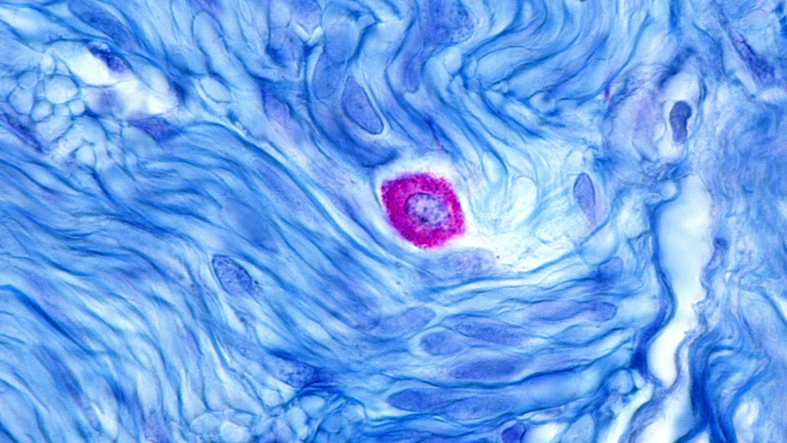celldexs-barzolvolimab-shows-unparalleled-efficacy-in-chronic-hives-despite-safety-hurdles