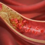 elucid-secures-55m-to-revolutionize-cardiovascular-diagnostics-with-ai-driven-precision