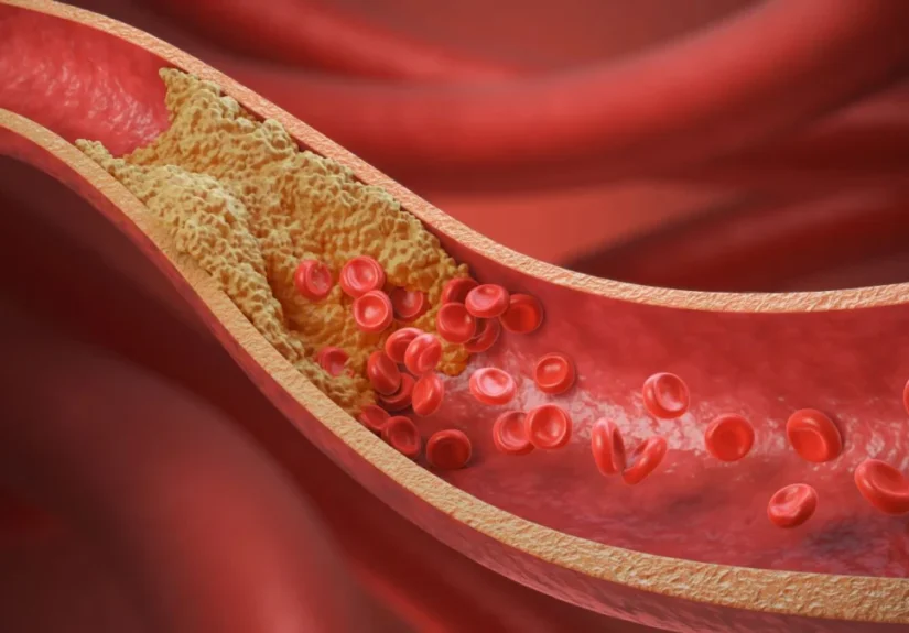 elucid-secures-55m-to-revolutionize-cardiovascular-diagnostics-with-ai-driven-precision