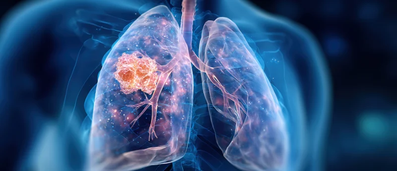 landmark-8-year-adaura-data-solidifies-osimertinib-as-cornerstone-of-adjuvant-therapy-in-resected-egfr-mutated-nsclc