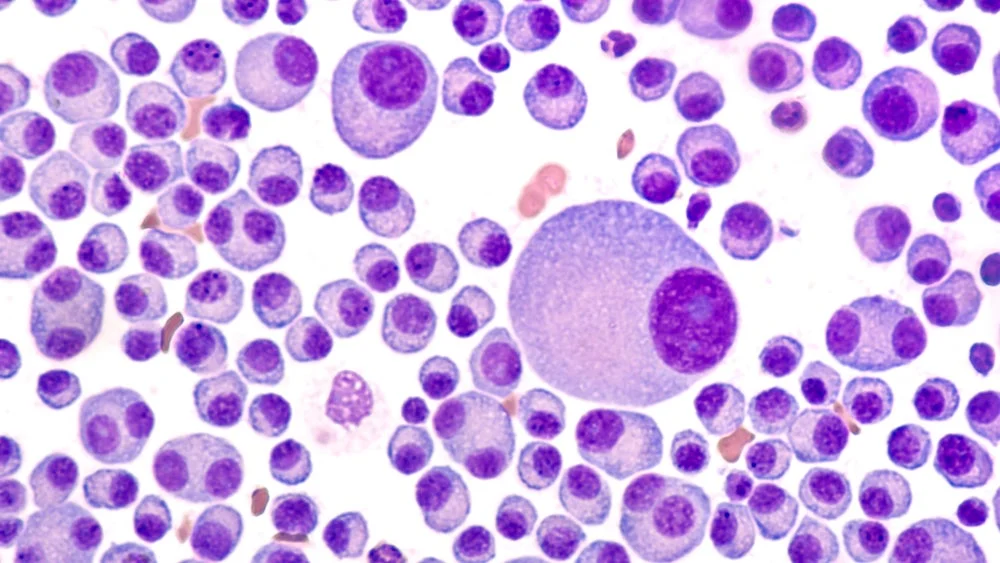 multiple-myeloma-landscape-heats-up-key-data-from-ims-2026-ignites-pharma-battle