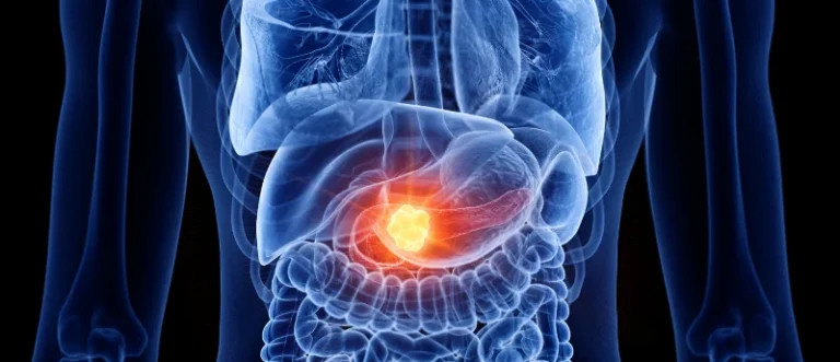 targeting-the-undruggable-the-paradigm-shift-in-metastatic-pancreatic-cancer-treatment