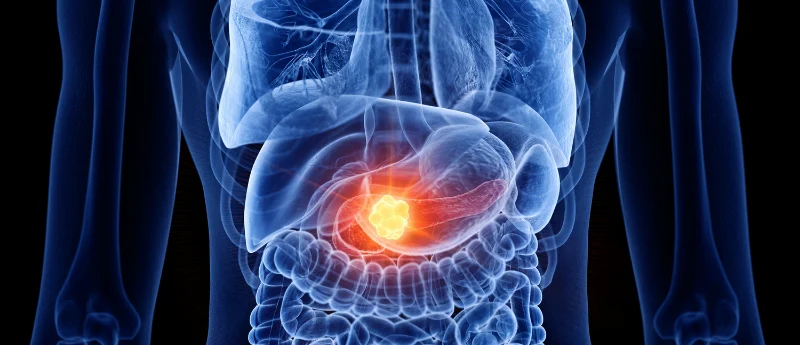 targeting-the-undruggable-the-paradigm-shift-in-metastatic-pancreatic-cancer-treatment
